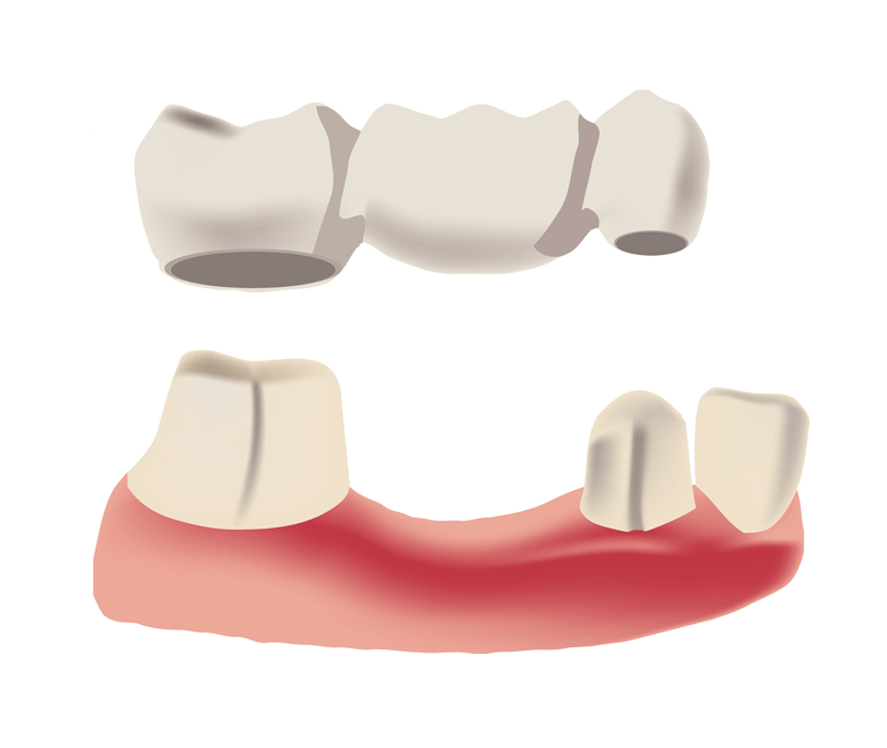 Enhance Your Smile with Dental Crowns in Cochrane at Bow River Dental
